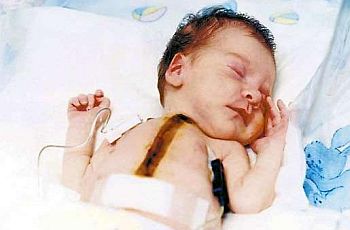 Bild_Xenotransplantation